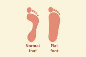 Flat Feet in Children